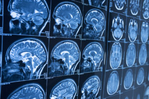 Why Choose Our Brain Injury Lawyers in Sandy Springs?